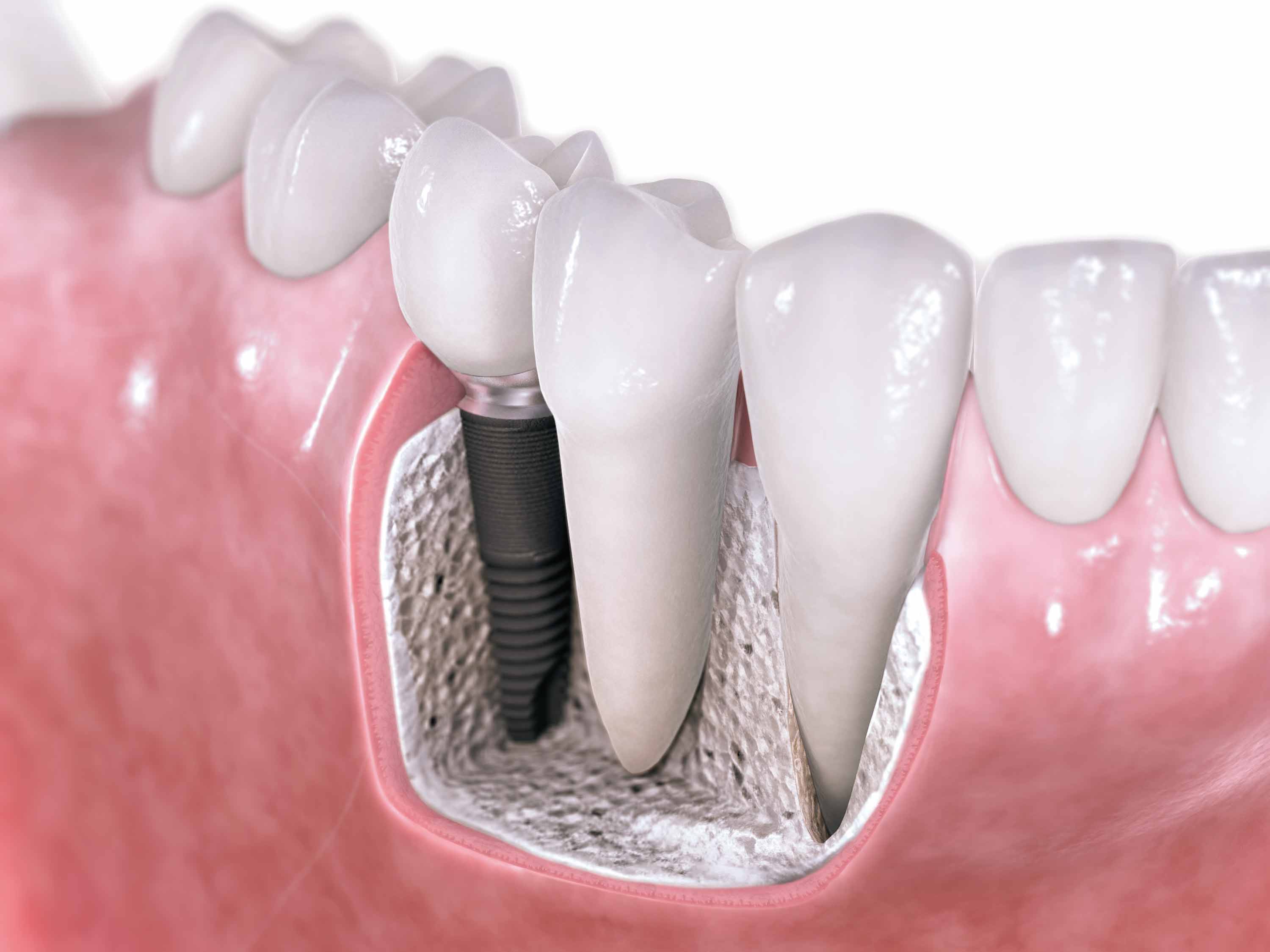 Implantes dentales