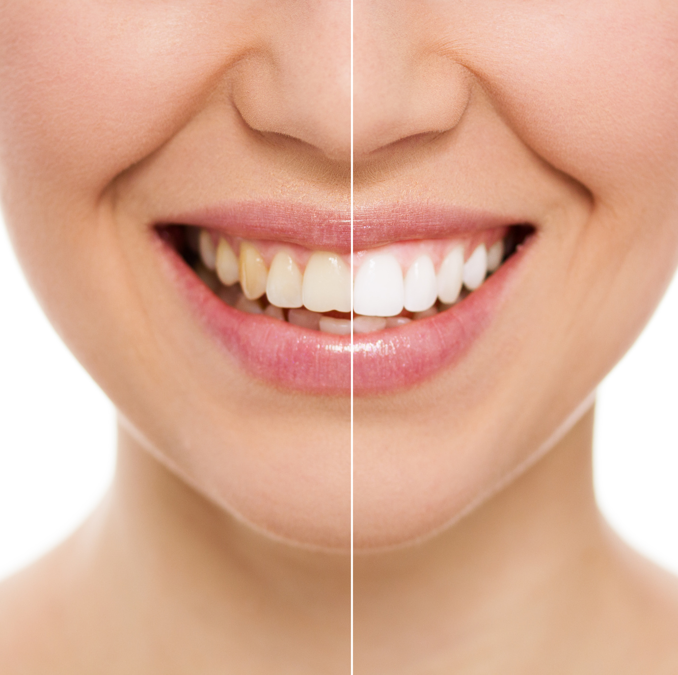 Blanqueamiento dental - Odontosalud Barracas